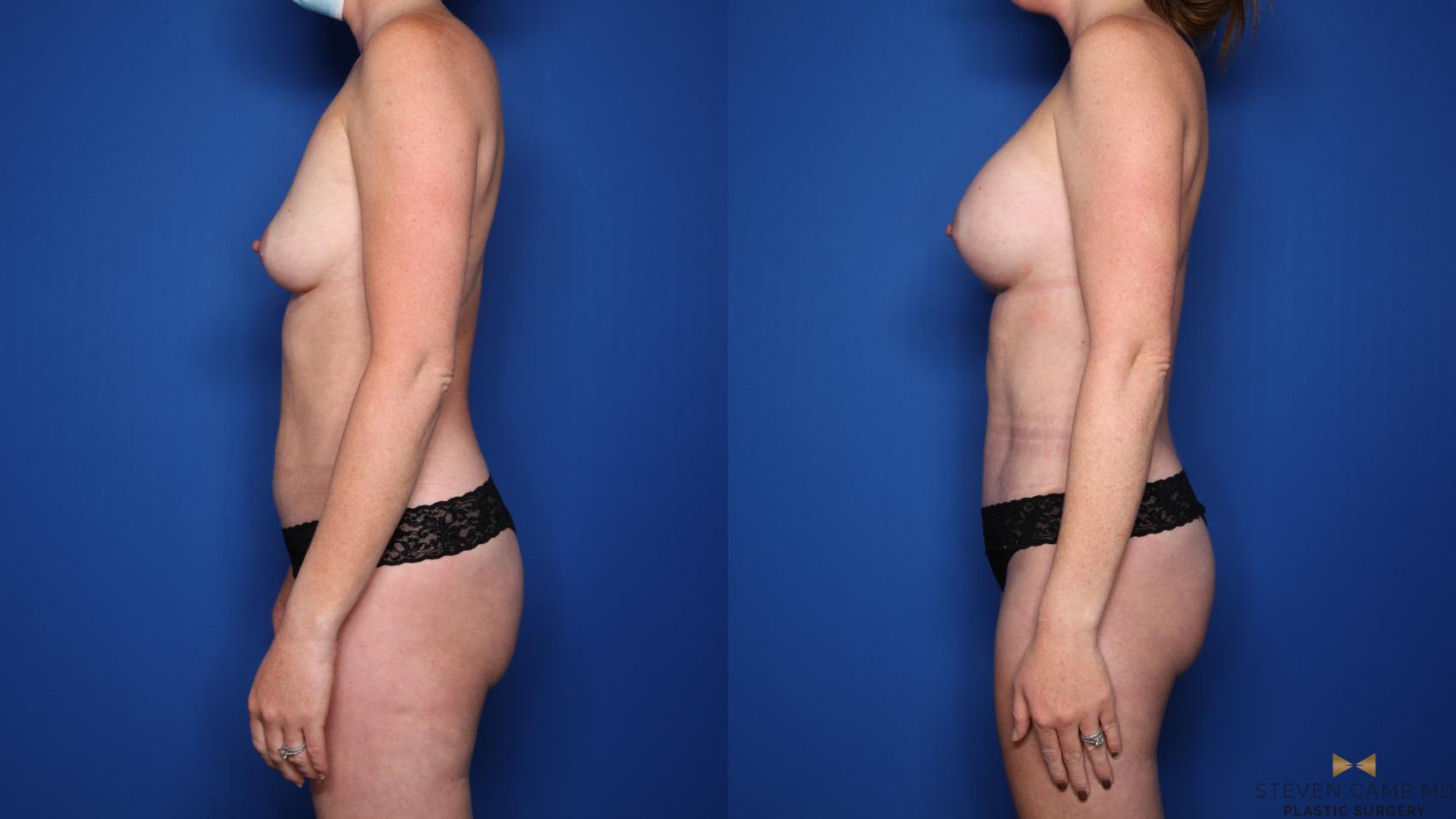 Before & After Renuvion Skin Tightening Case 519 Left Side View in Fort Worth & Arlington, Texas