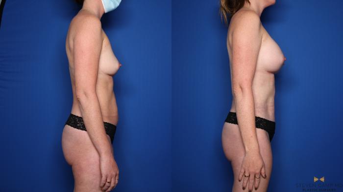 Before & After Renuvion Skin Tightening Case 519 Right Side View in Fort Worth & Arlington, Texas