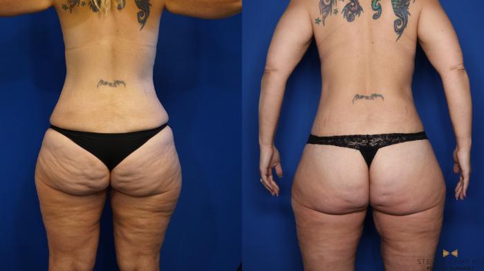 Before & After Renuvion Skin Tightening Case 520 Back View in Fort Worth & Arlington, Texas