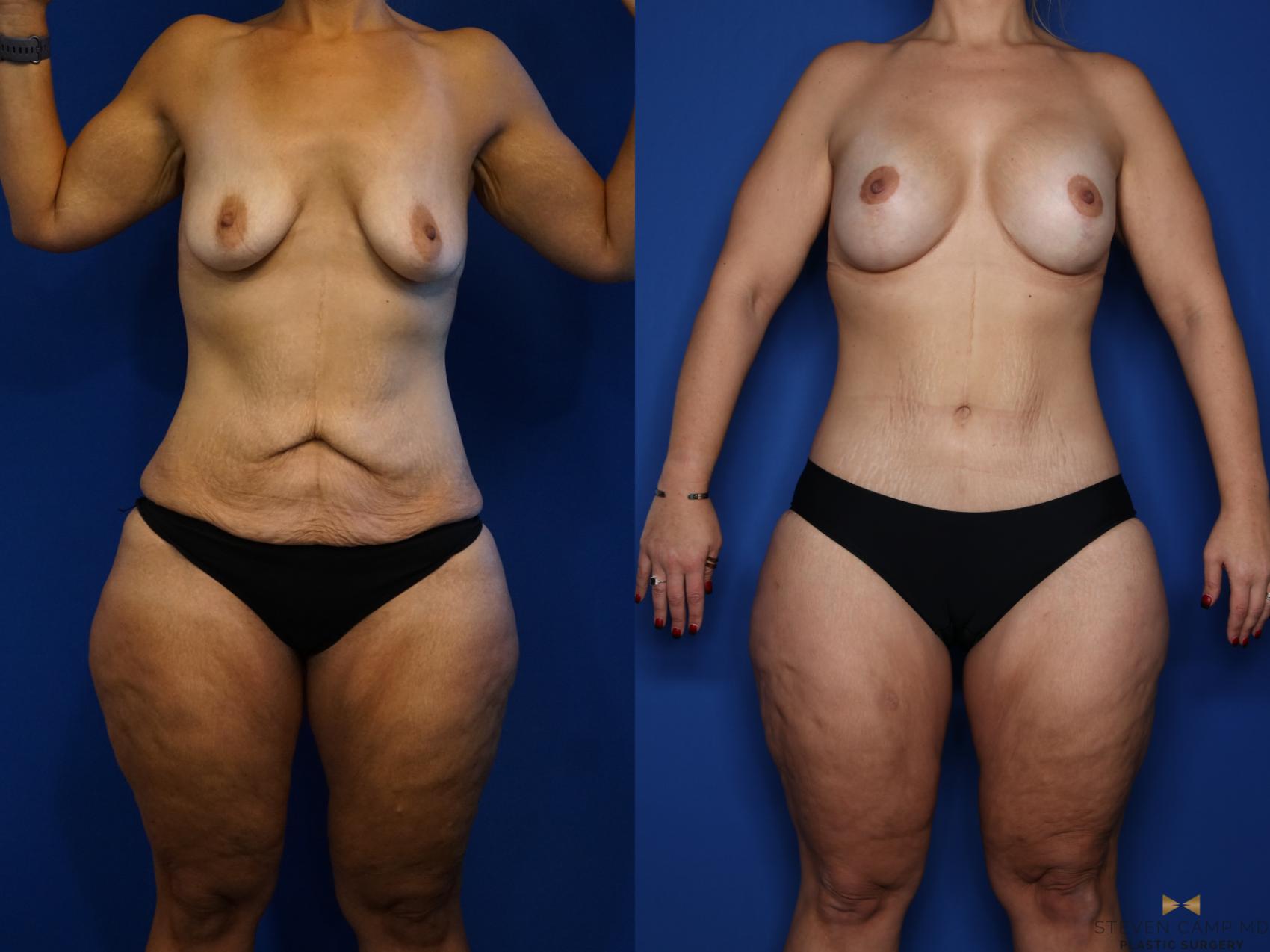 Before & After Renuvion Skin Tightening Case 520 Front View in Fort Worth & Arlington, Texas