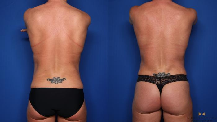 Before & After Tummy Tuck Case 523 Back View in Fort Worth & Arlington, Texas