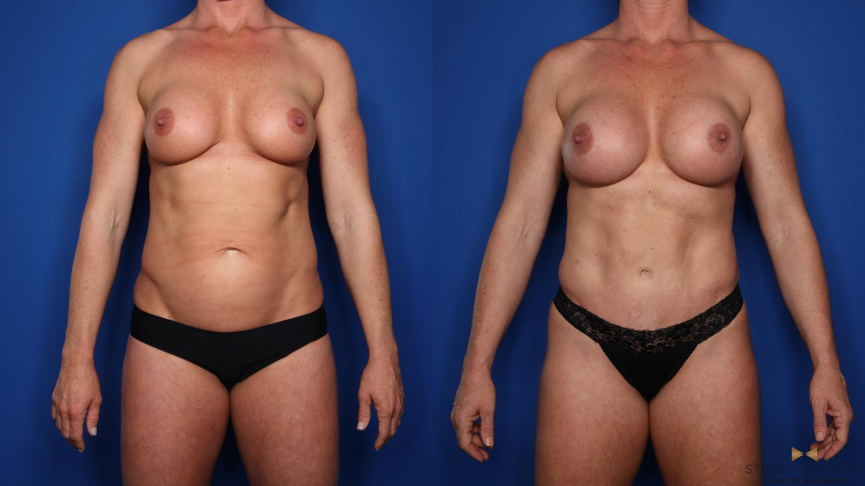 Before & After Tummy Tuck Case 523 Front View in Fort Worth, Texas