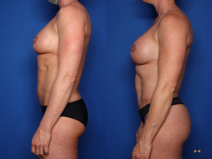 Before & After Renuvion Skin Tightening Case 523 Left Side View in Fort Worth & Arlington, Texas