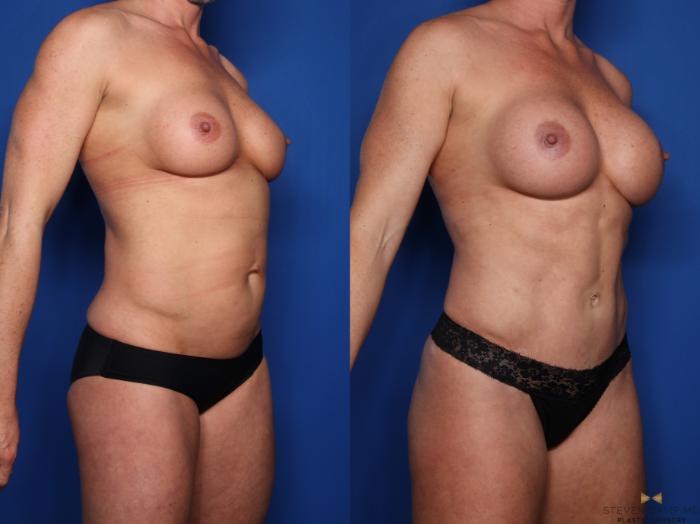 Before & After Liposuction Case 523 Right Oblique View in Fort Worth & Arlington, Texas