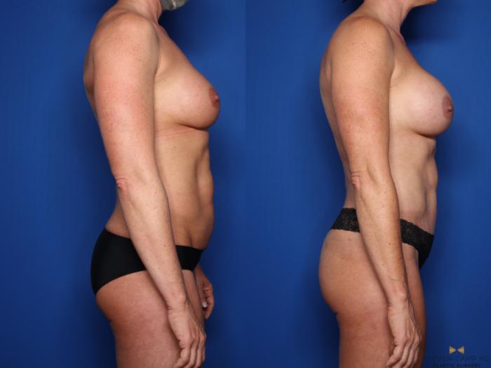 Before & After Renuvion Skin Tightening Case 523 Right Side View in Fort Worth & Arlington, Texas