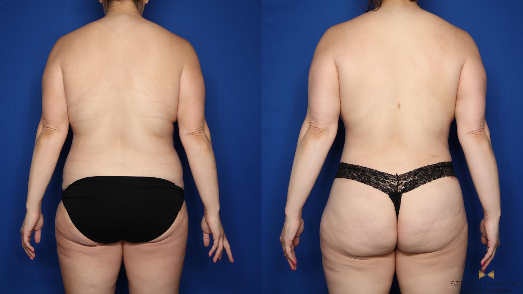 Before & After Mommy Makeover Case 547 Back View in Fort Worth & Arlington, Texas