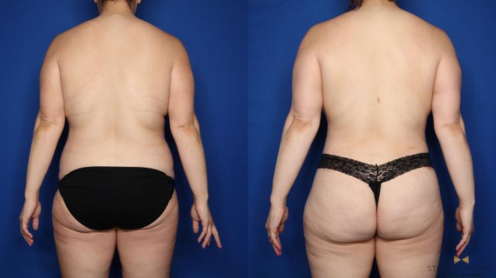 Before & After Mommy Makeover Case 547 Back View in Fort Worth & Arlington, Texas