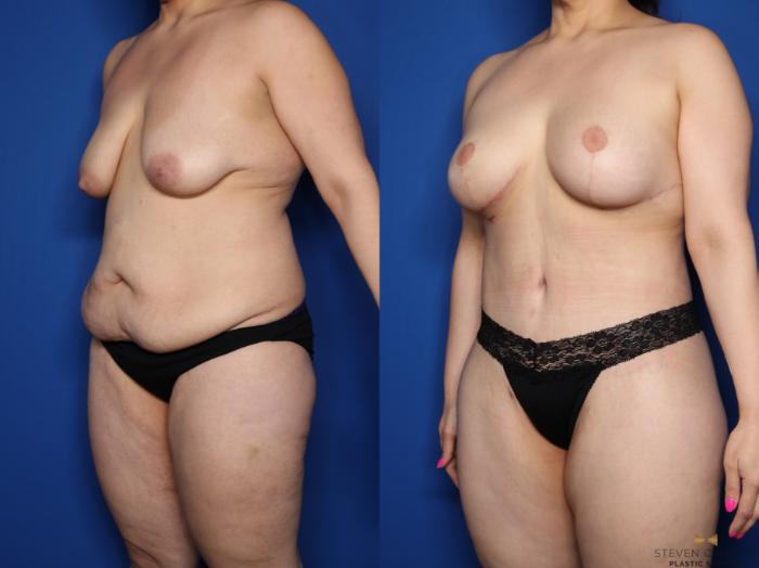 Before & After Mommy Makeover Case 547 Left Oblique View in Fort Worth & Arlington, Texas