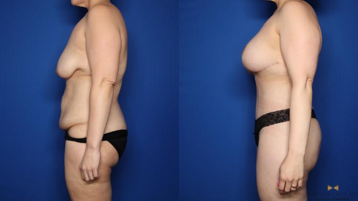 Before & After Mommy Makeover Case 547 Left Side View in Fort Worth & Arlington, Texas