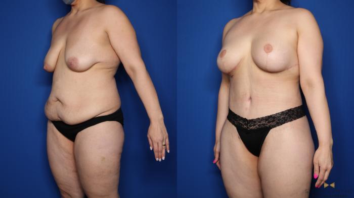 Before & After Mommy Makeover Case 547 Right Oblique View in Fort Worth & Arlington, Texas