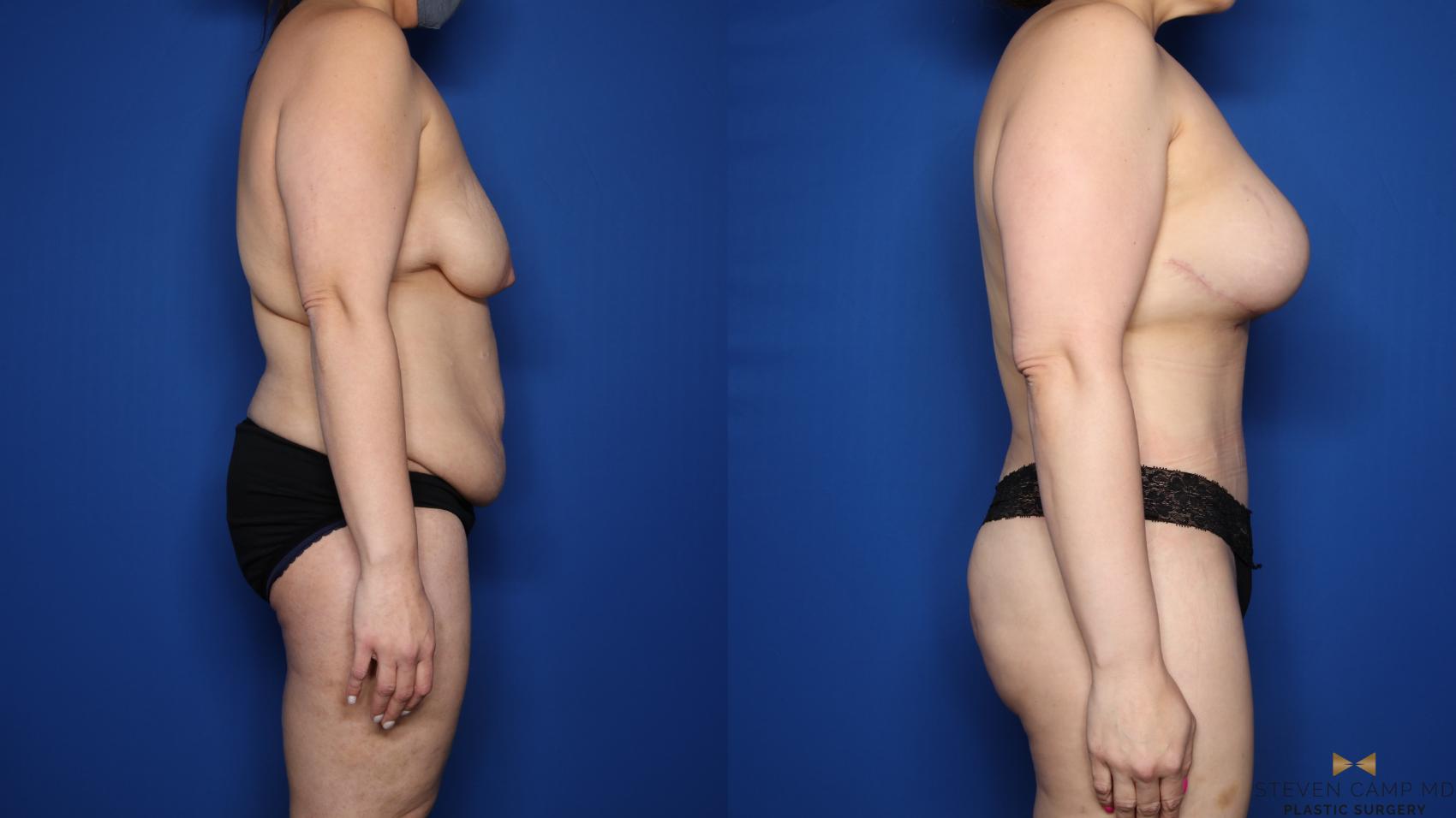 Before & After Mommy Makeover Case 547 Right Side View in Fort Worth & Arlington, Texas