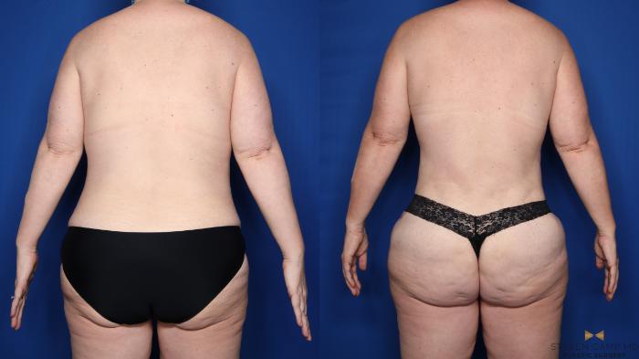 Before & After Mommy Makeover Case 548 Back View in Fort Worth & Arlington, Texas