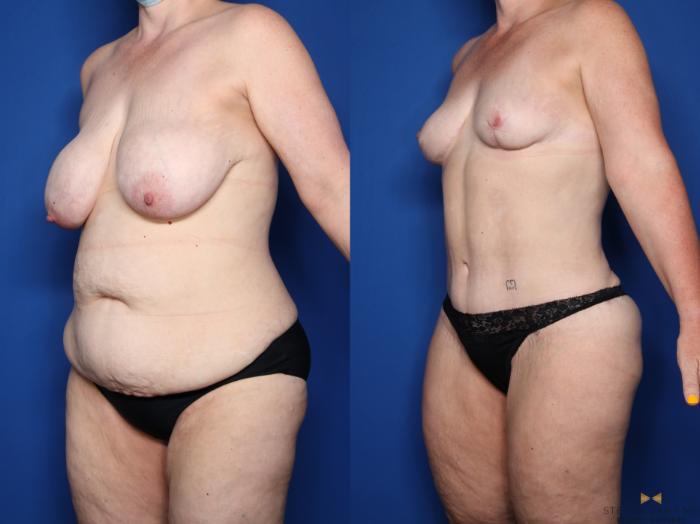 Before & After Mommy Makeover Case 548 Left Oblique View in Fort Worth & Arlington, Texas
