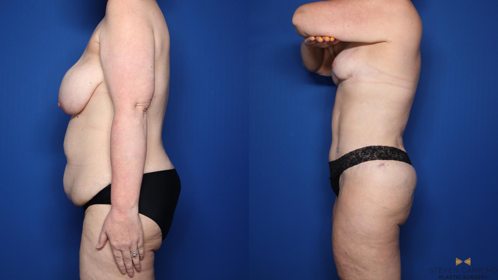 Before & After Mommy Makeover Case 548 Left Side View in Fort Worth & Arlington, Texas