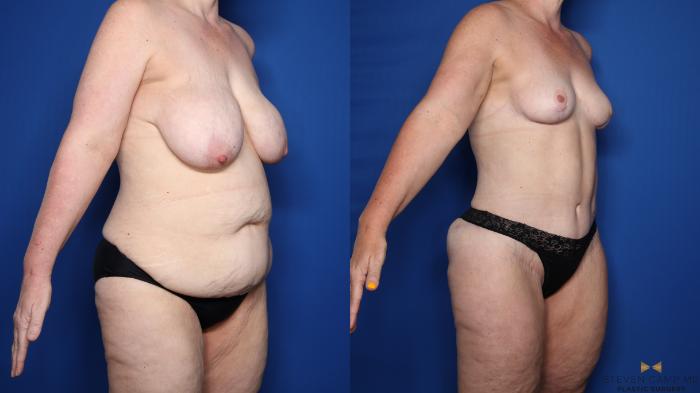 Before & After Mommy Makeover Case 548 Right Oblique View in Fort Worth & Arlington, Texas