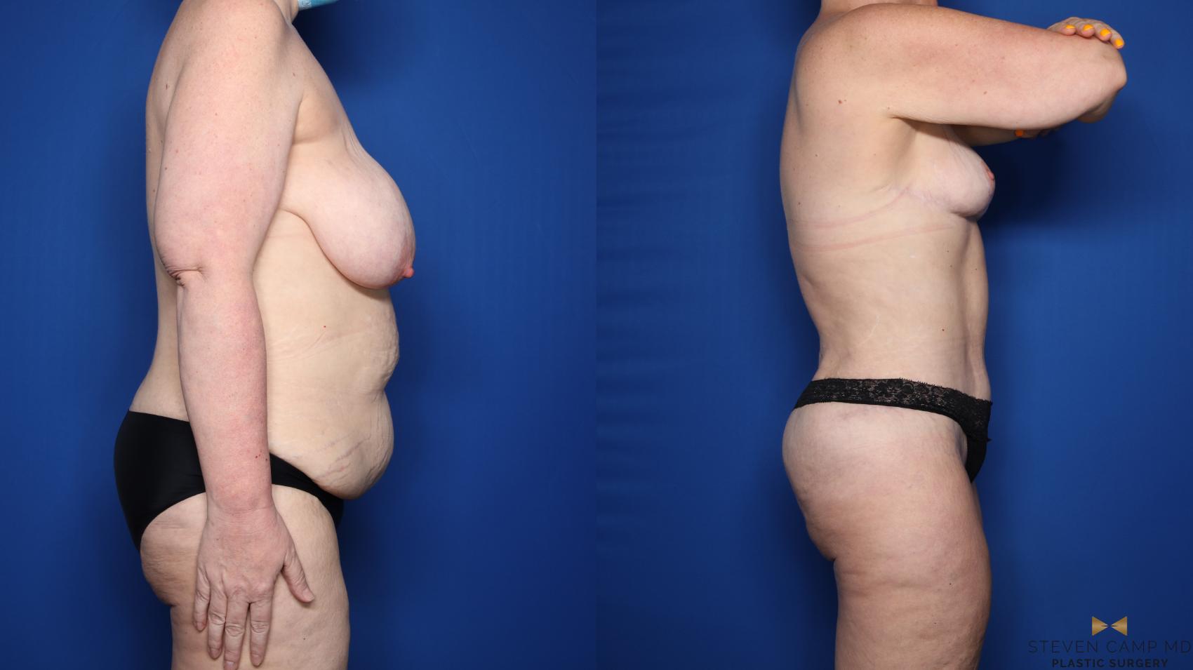Before & After Mommy Makeover Case 548 Right Side View in Fort Worth & Arlington, Texas