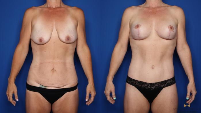 Before & After Breast Lift (Breast Mastopexy with Implants) Case 552 Front View in Fort Worth & Arlington, Texas