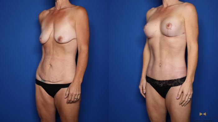 Before & After Liposuction Case 552 Left Oblique View in Fort Worth & Arlington, Texas