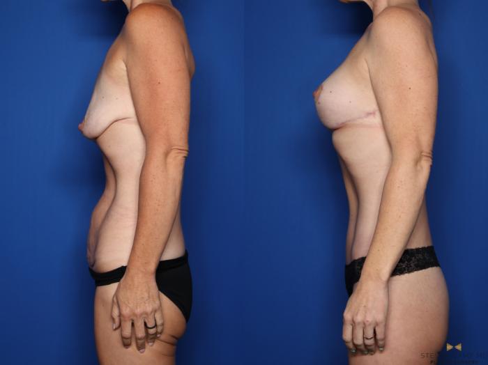 Before & After Breast Lift (Breast Mastopexy with Implants) Case 552 Left Side View in Fort Worth & Arlington, Texas