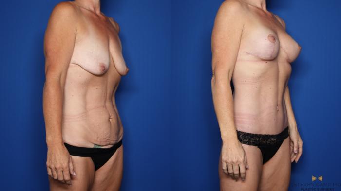 Before & After Breast Lift (Breast Mastopexy with Implants) Case 552 Right Oblique View in Fort Worth & Arlington, Texas