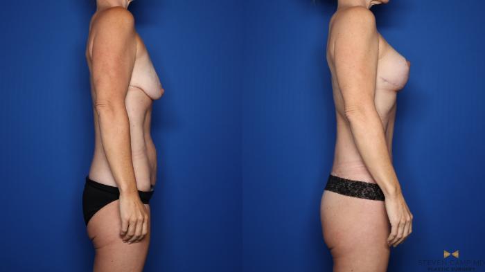 Before & After Breast Lift (Breast Mastopexy with Implants) Case 552 Right Side View in Fort Worth & Arlington, Texas
