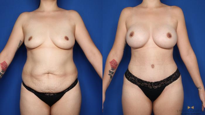 Before & After Liposuction Case 579 Front View in Fort Worth & Arlington, Texas