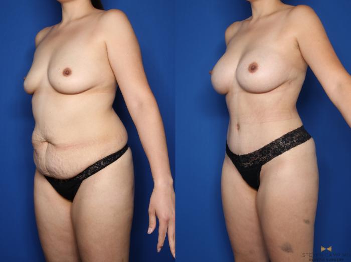 Before & After Mommy Makeover Case 579 Left Oblique View in Fort Worth, Texas