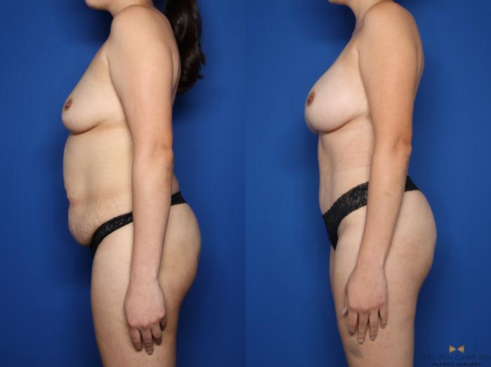 Before & After Tummy Tuck Case 579 Left Side View in Fort Worth & Arlington, Texas