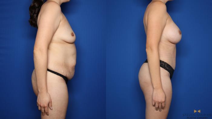 Before & After Liposuction Case 579 Right Side View in Fort Worth & Arlington, Texas