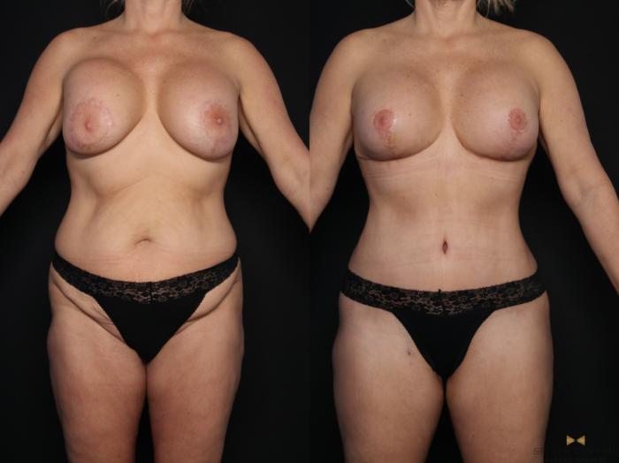 Before & After Breast Implant Exchange, Mastopexy & Internal Bra Case 608 Front View in Fort Worth, Texas