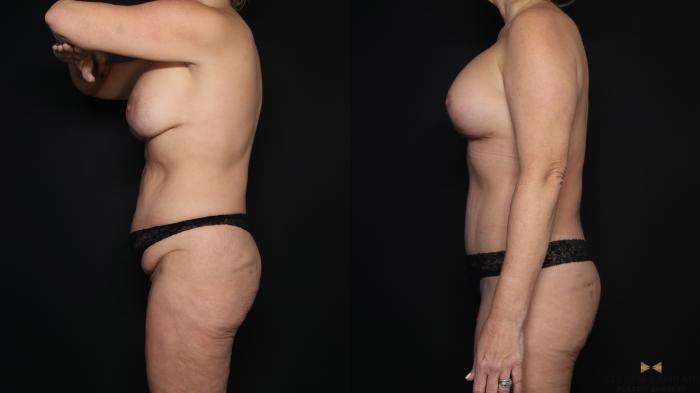 Before & After Tummy Tuck Case 608 Left Side View in Fort Worth & Arlington, Texas