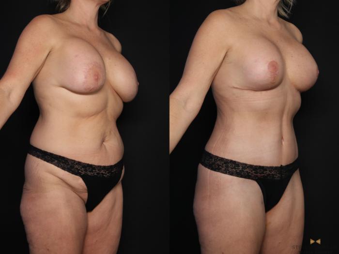 Before & After Breast Implant Exchange (Breast Revision) Case 608 Right Oblique View in Fort Worth & Arlington, Texas