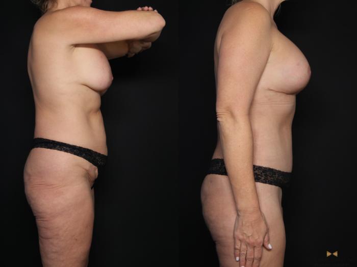 Before & After Tummy Tuck Case 608 Right Side View in Fort Worth & Arlington, Texas