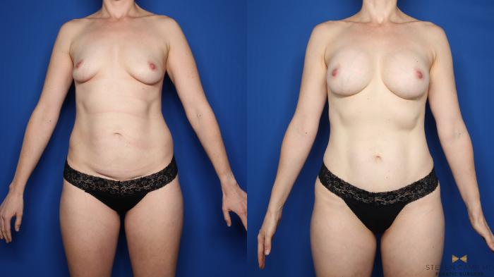 Before & After Breast Augmentation Case 620 Front View in Fort Worth & Arlington, Texas