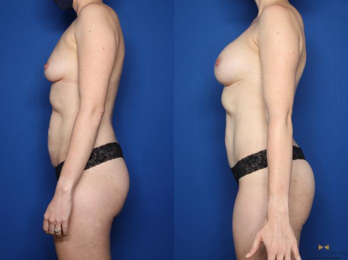 Before & After Breast Augmentation Case 620 Left Side View in Fort Worth & Arlington, Texas