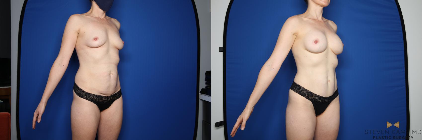 Before & After Breast Augmentation Case 620 Right Oblique View in Fort Worth & Arlington, Texas