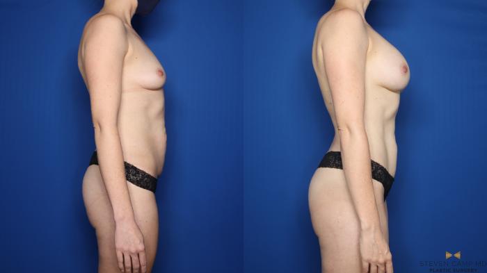 Before & After Breast Augmentation Case 620 Right Side View in Fort Worth & Arlington, Texas