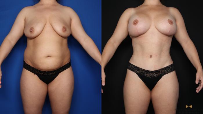 Before & After Tummy Tuck Case 621 Front View in Fort Worth & Arlington, Texas