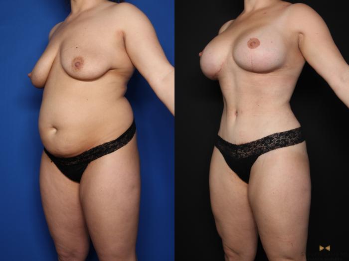 Before & After Tummy Tuck Case 621 Left Oblique View in Fort Worth & Arlington, Texas