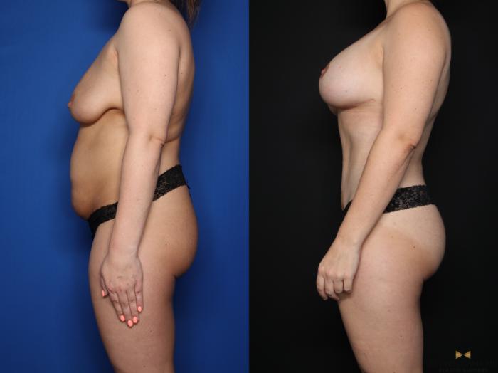 Before & After Mommy Makeover Case 621 Left Side View in Fort Worth & Arlington, Texas