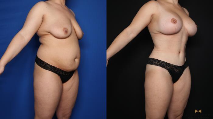Before & After Mommy Makeover Case 621 Right Oblique View in Fort Worth & Arlington, Texas