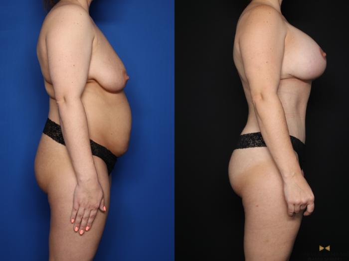 Before & After Liposuction Case 621 Right Side View in Fort Worth & Arlington, Texas