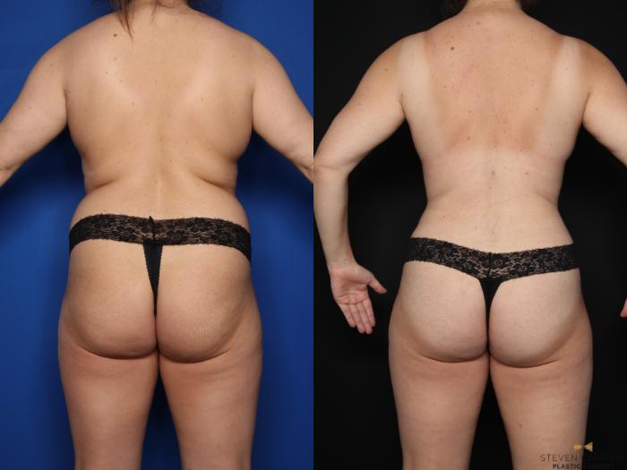 Before & After Mommy Makeover Case 622 Back View in Fort Worth & Arlington, Texas