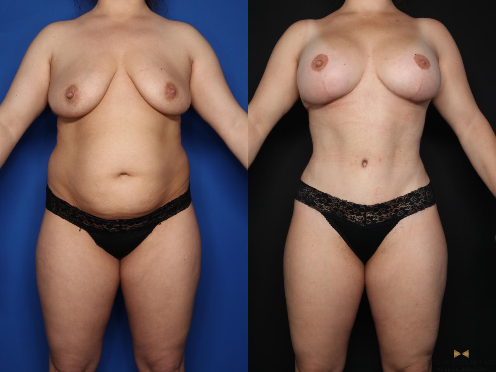 Before & After Mommy Makeover Case 622 Front View in Fort Worth & Arlington, Texas