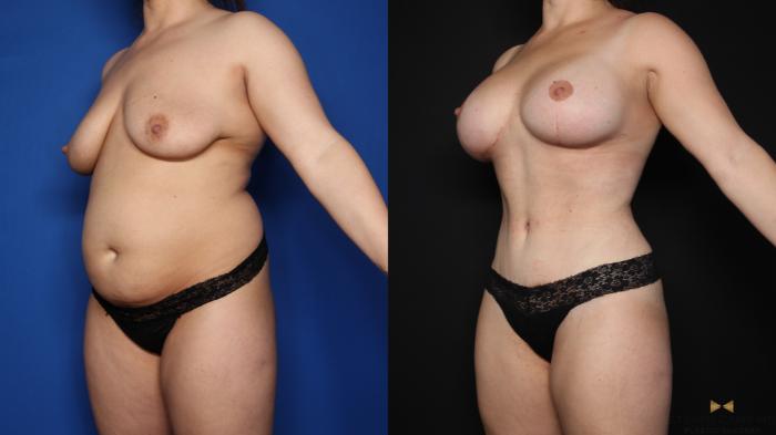 Before & After Mommy Makeover Case 622 Left Oblique View in Fort Worth & Arlington, Texas