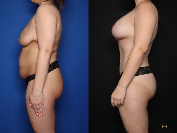 Before & After Mommy Makeover Case 622 Left Side View in Fort Worth & Arlington, Texas