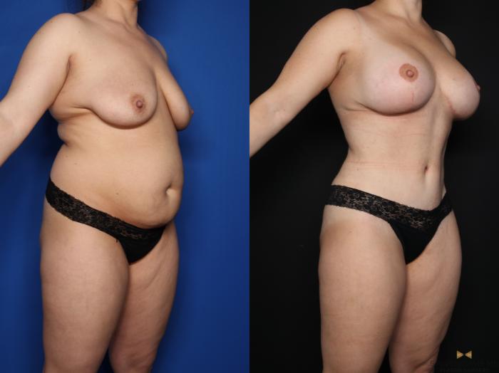 Before & After Mommy Makeover Case 622 Right Oblique View in Fort Worth & Arlington, Texas