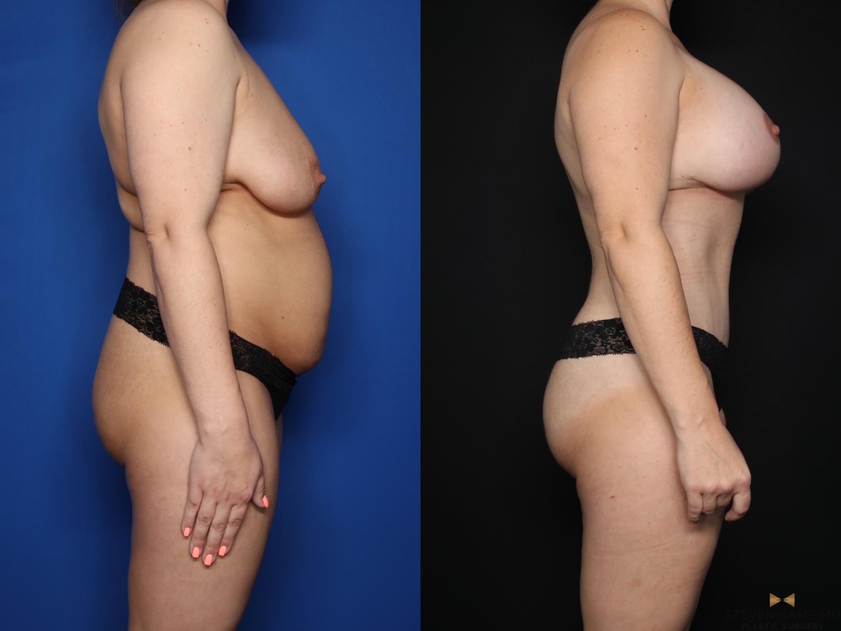 Before & After Mommy Makeover Case 622 Right Side View in Fort Worth & Arlington, Texas