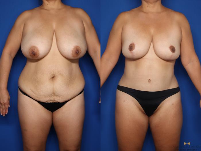 Before & After Tummy Tuck Case 623 Front View in Fort Worth & Arlington, Texas