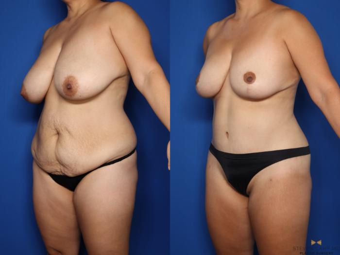 Before & After Tummy Tuck Case 623 Left Oblique View in Fort Worth & Arlington, Texas